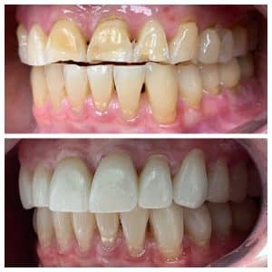 Dental Veneers Near Me