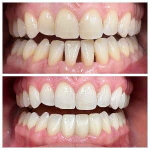 Dental Veneers Near Me