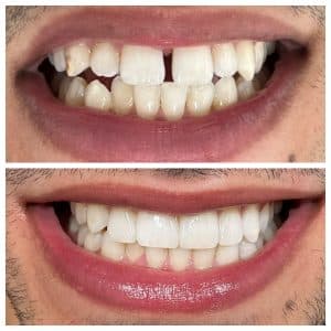 Dental Veneers Near Me