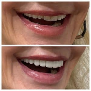 Dental Veneers Near Me