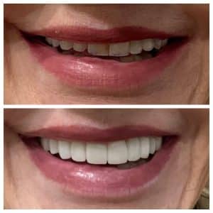 Dental Veneers Near Me
