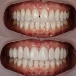 cosmetic dentist johns creek veneers before and after