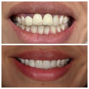 cosmetic dentist johns creek veneers before and after