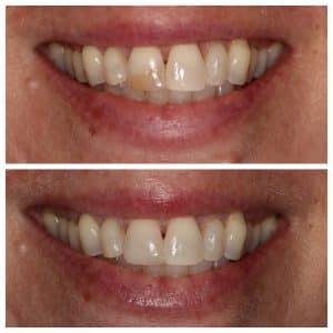 cosmetic dentist johns creek veneers