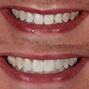 cosmetic dentist johns creek veneers before and after