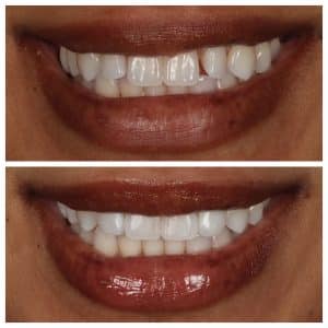 cosmetic dentist johns creek veneers