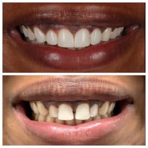 cosmetic dentist johns creek veneers before and after
